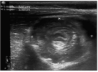 intussusception_sonographic_view1.png