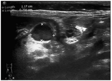 mesenterial_lymphadenitis_sonographic_view.png