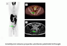 18F-PSMA-1007 un 68Ga-PSMA-11 PET/CT mērķētas molekulāras attēldiagnostikas loma prostatas vēža recidīva multimodālā izmeklēšanā