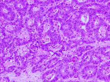 Disertācijas pētījums par faktoriem, kas ietekmē resnās zarnas vēža attīstību un izplatību