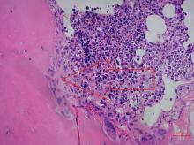 Jurija Nazarova promocijas darbs par multiplo mielomu