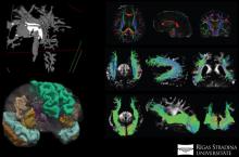 Disertācijas pētījums par radioloģisko biomarķieru nozīmi kognitīvo traucējumu diagnostikā
